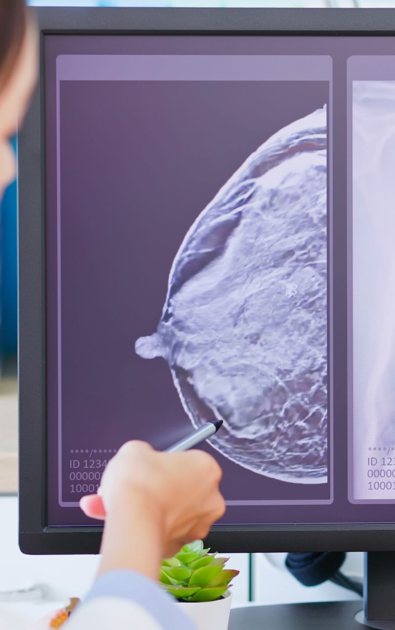 cancro da mama triplo-negativo metastático MN